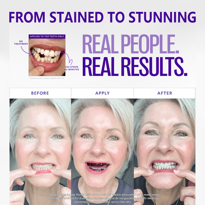 😁 SmileFitPro™ V36 Whitening Strips