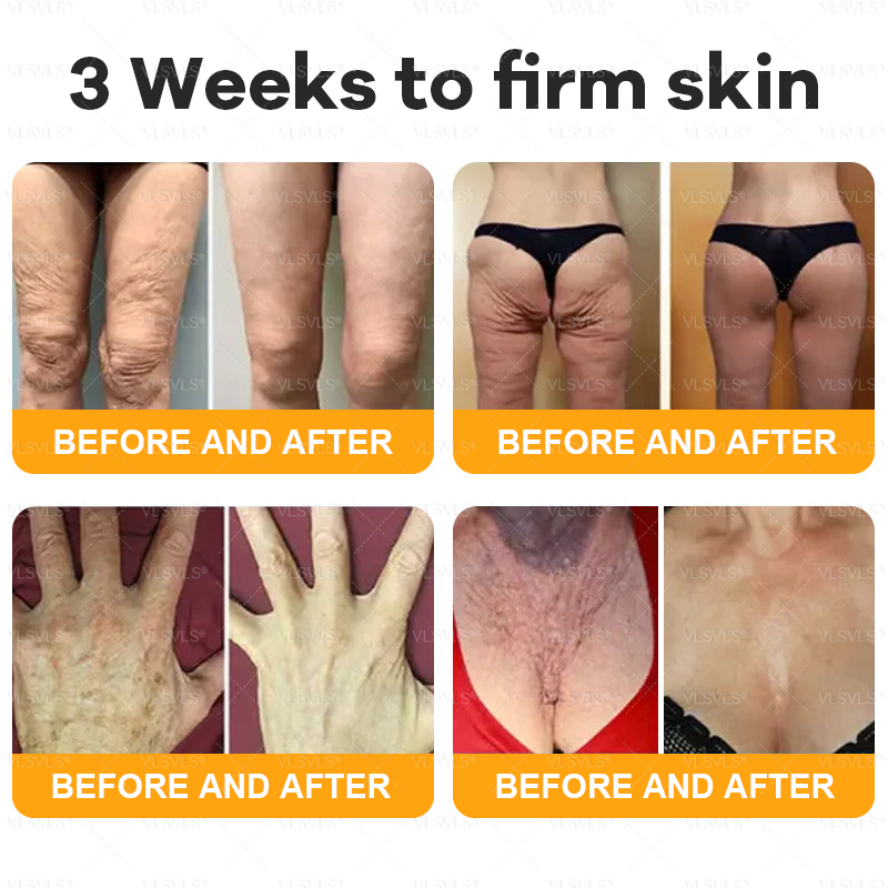 VLSVLS® Bee Venom Comprehensive Cream  👩‍⚕️⏰ LAST DAY 80% OFF (Sagging Skin, Fine Lines, Loss of Firmness, Flat Bust, Drooping Hips, and More)