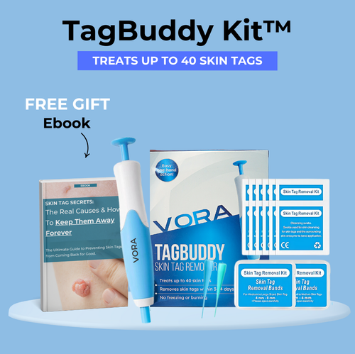 TagBuddy Kit – No More Skin Tags